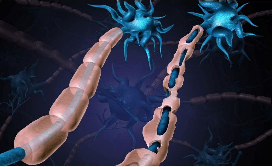 Understanding Multiple Sclerosis and Incontinence